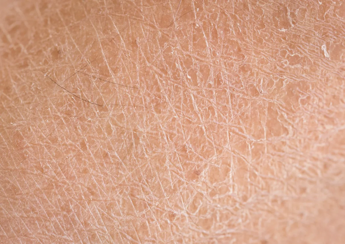 Peau déshydratée, texture de la peau en gros plan